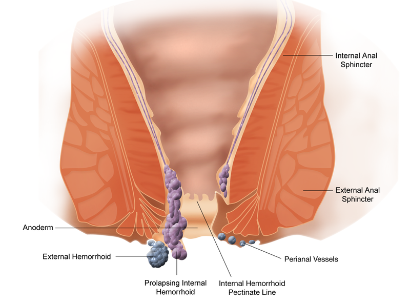 Colorectal Hemorrhoid Diseases ( Dr. Rasoul Azizi , MD ) Colorectal Surgery Iran