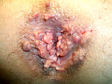 Anal Warts Image - Colon Rectal Diseases