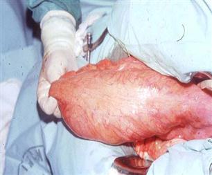 MegaColon Disease