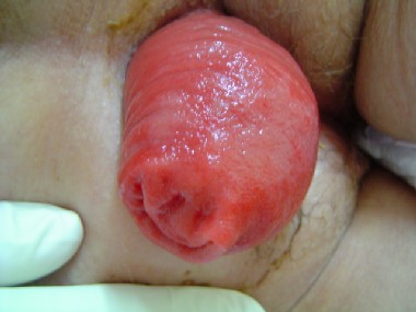 Rectal Prolapse image